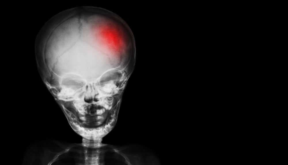 La afasia suele presentarse después de un accidente cerebrovascular.