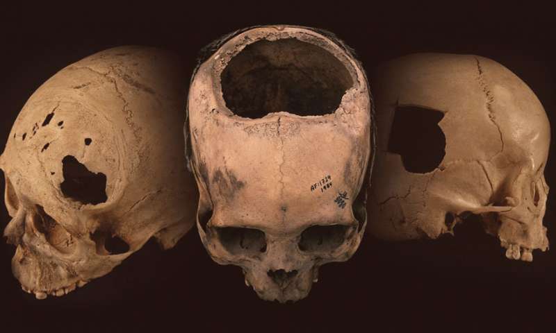 La trepanación es uno de los procedimientos médicos más antiguos.