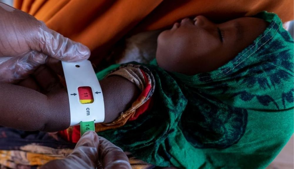 Examen a un niño somalí de 7 meses desnutrido, a causa de la grave sequía que sufre Somalia. Examen a un niño somalí de 7 meses desnutrido, a causa de la grave sequía que sufre Somalia.