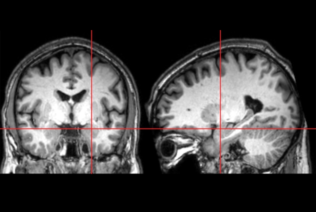 La nueva investigación ha encontrado que la amígdala del cerebro crece demasiado rápido en el primer año de vida