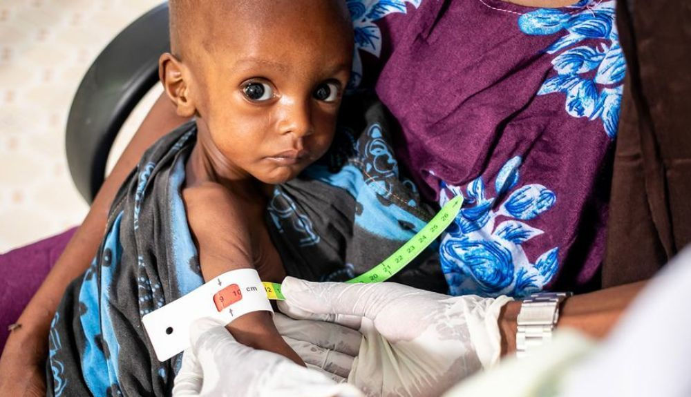 Este pequeño de un año con desnutrición grave recibe atención en un hospital de Dolow, Etiopía. Este pequeño de un año con desnutrición grave recibe atención en un hospital de Dolow, Etiopía.