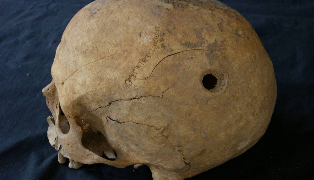 Cráneo trepanado de la Edad Media. Cráneo trepanado de la Edad Media.