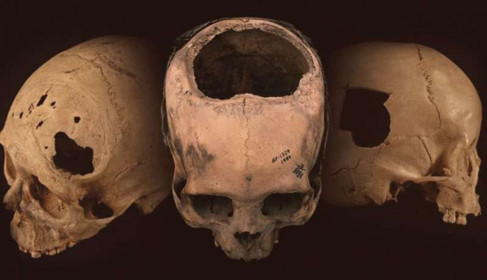 La trepanacion es uno de los procedimientos medicos mas antiguos.jpeg La trepanacion es uno de los procedimientos medicos mas antiguos.jpeg