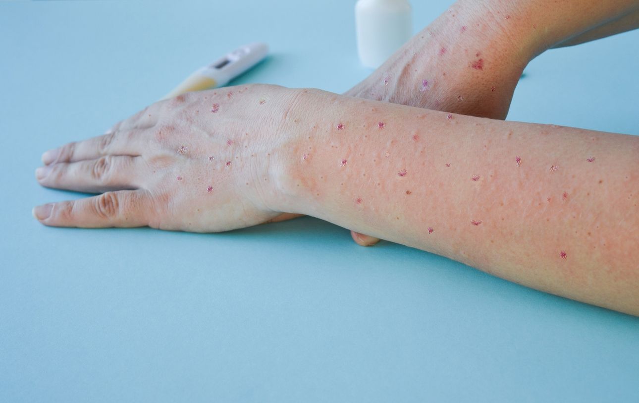 El virus de la viruela del mono se ha convertido en un nuevo problema sanitario mundial.