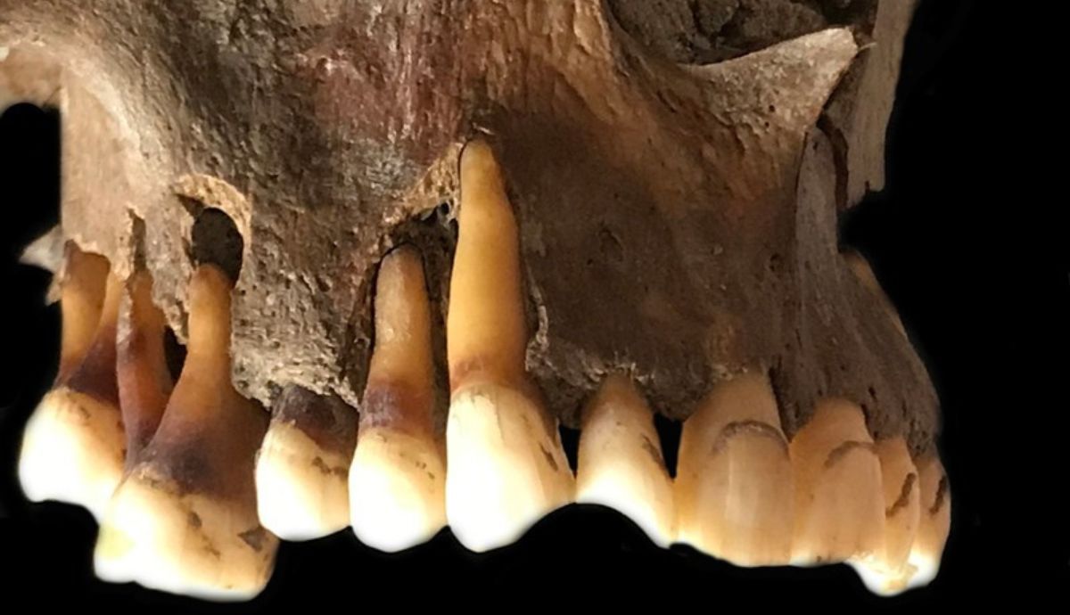 El ADN extraído de los dientes está llevando a una visión sorprendente del herpes labial.