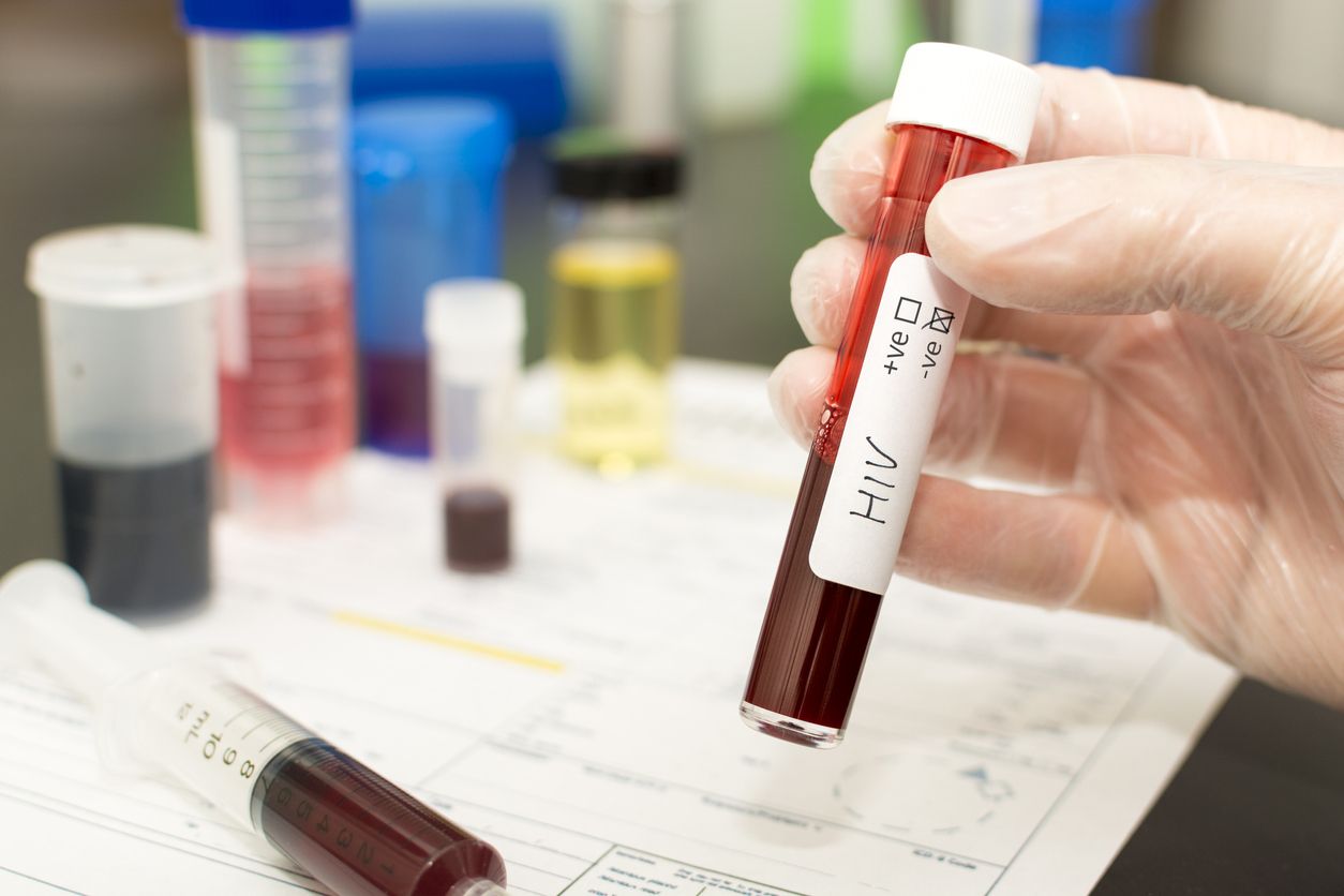 Los científicos pudieron rastrear la primera transmisión del virus de inmunodeficiencia en simios (SIV) al VIH en humanos.