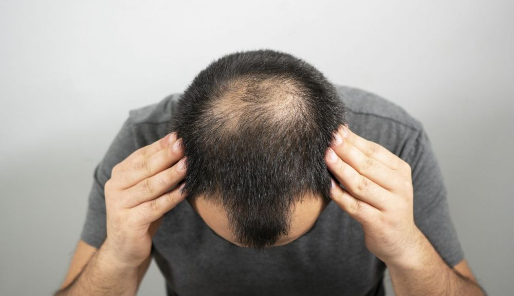 Este tratamiento para la alopecia está permitido en EE UU y España.
