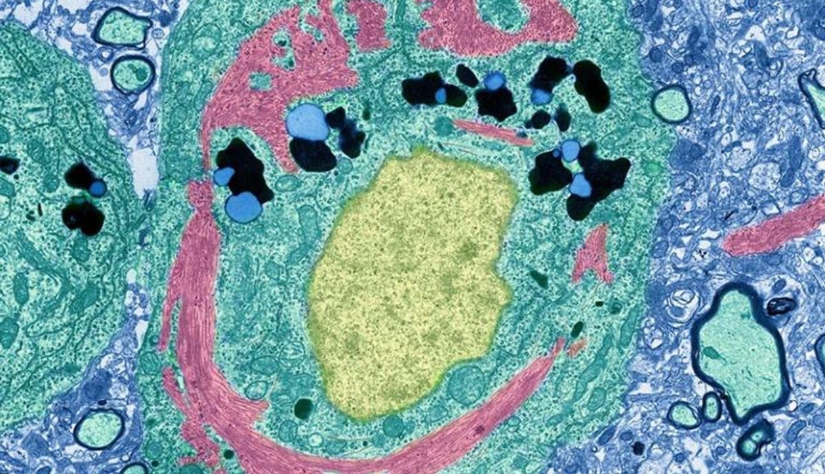 Una neurona (verde) de una persona con la enfermedad de Alzheimer incluye un complejo proteico inusual (rosa) que rodea el núcleo (amarillo).