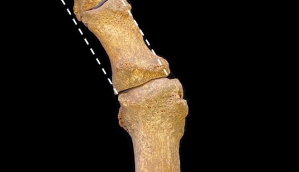 Huesos medievales excavados del pie que muestran hallux valgus, con desviación lateral. Huesos medievales excavados del pie que muestran hallux valgus, con desviación lateral.