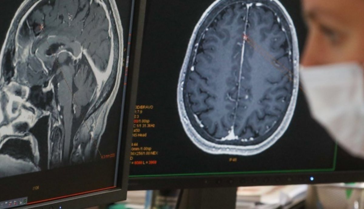 Desde el comienzo de la pandemia, los investigadores han estado tratando de entender cómo el coronavirus SARS CoV 2 afecta al cerebro. Foto: Nature.