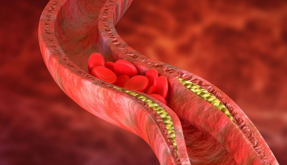 La aterosclerosis es una acumulación de placas de colesterol en las paredes de las arterias, que causa obstrucción del flujo sanguíneo. La aterosclerosis es una acumulación de placas de colesterol en las paredes de las arterias, que causa obstrucción del flujo sanguíneo.