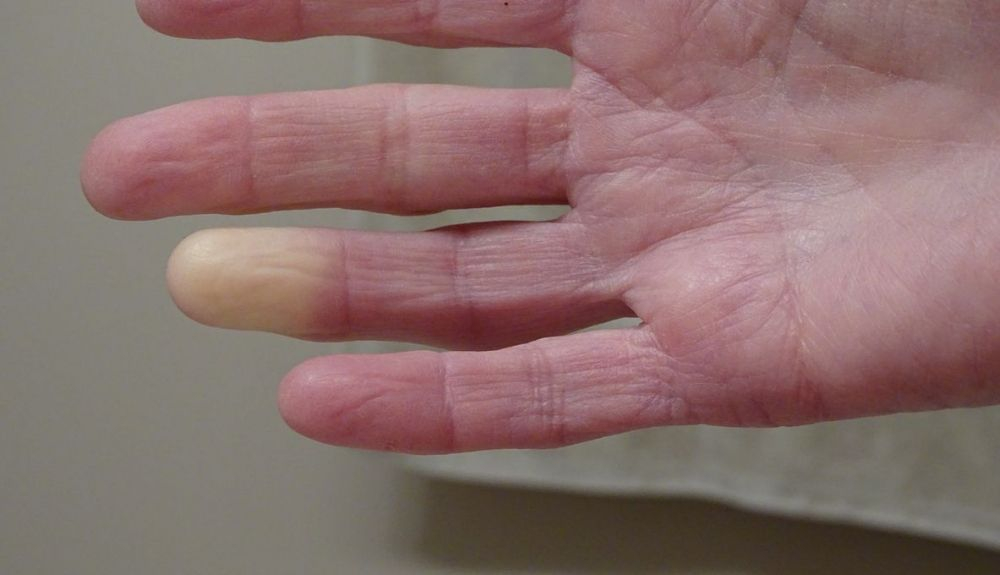 Mano de adultos con el síndrome de Raynaud.