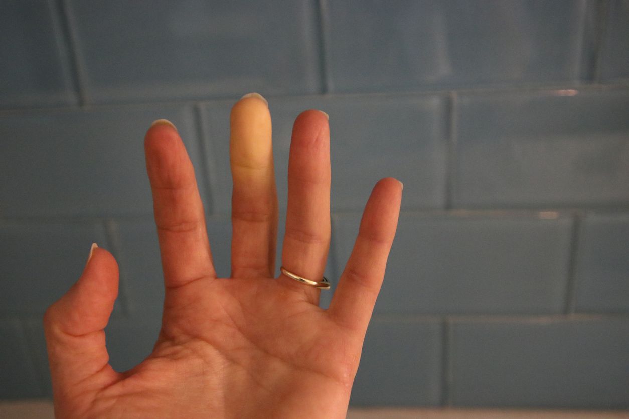 Una mano afectada por el síndrome de Raynaud.