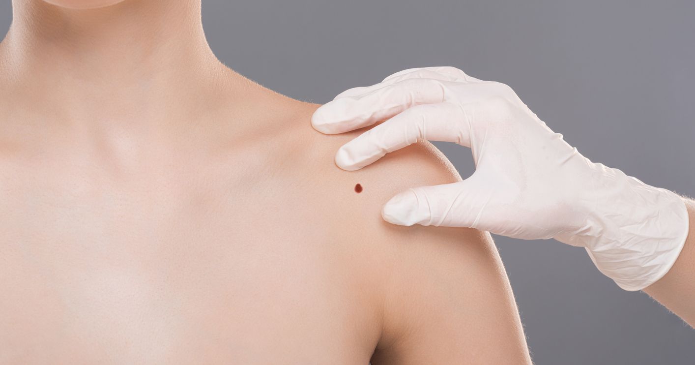 En verano, la piel con pecas o lunares necesita de un especial cuidado. Foto: IStock.
