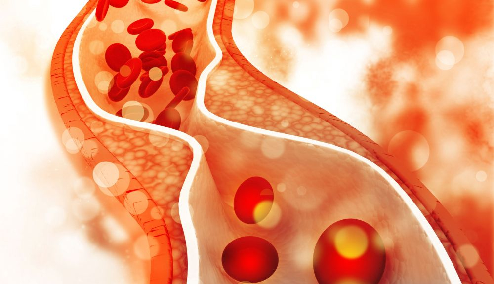 el LDL tiende a unirse a las paredes de las arterias, y si se acumula demasiado el engrosamiento de las mismas no deja fluir la sangre correctamente. el LDL tiende a unirse a las paredes de las arterias, y si se acumula demasiado el engrosamiento de las mismas no deja fluir la sangre correctamente.