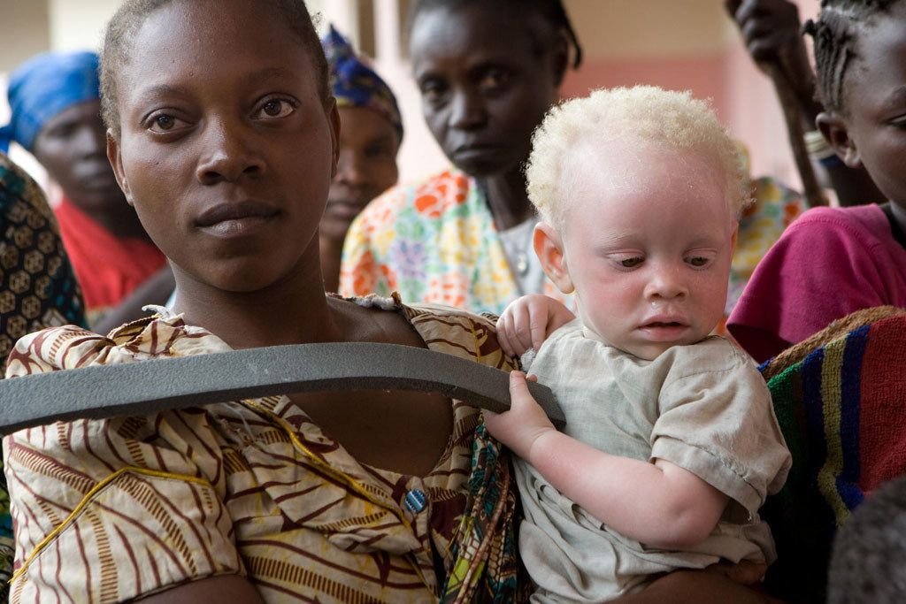 Ser una persona con albinismo en África es muy peligroso
