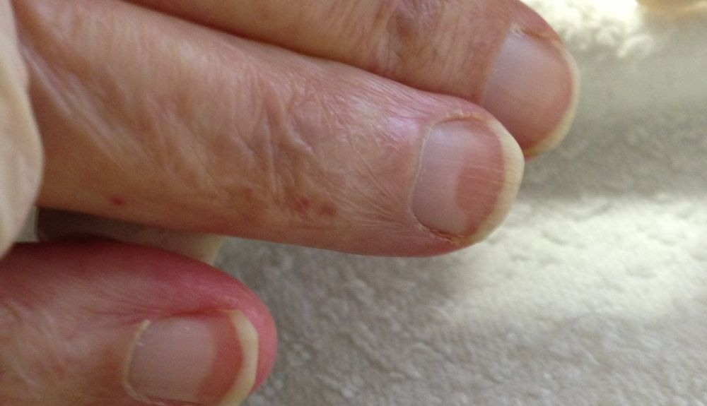 Ejemplo de uñas de Terry. Ejemplo de uñas de Terry.