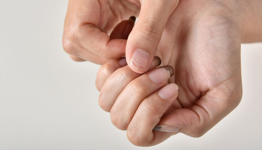 El problema de las uñas quebradiza puede tener su origen en el envejecimiento. El problema de las uñas quebradiza puede tener su origen en el envejecimiento.