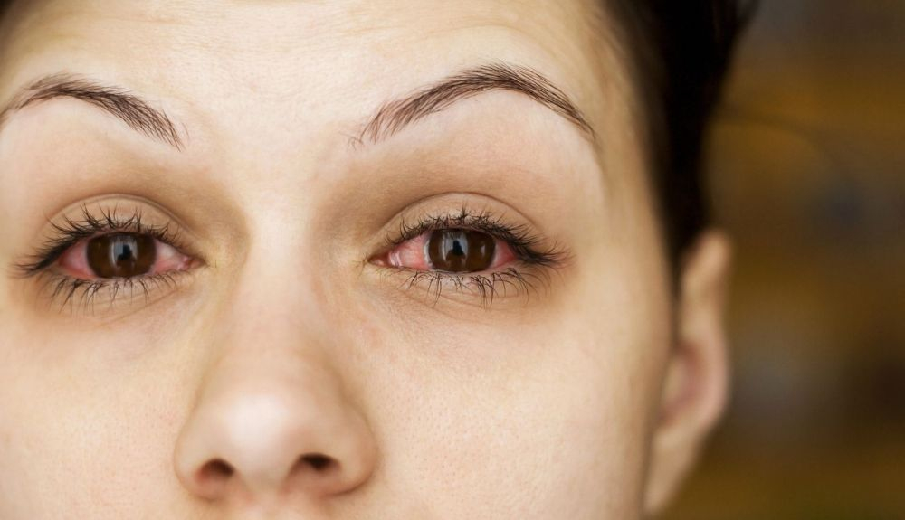 Los ojos irritados son síntomas de Covid 19, según diversos estudios. Los ojos irritados son síntomas de Covid 19, según diversos estudios.
